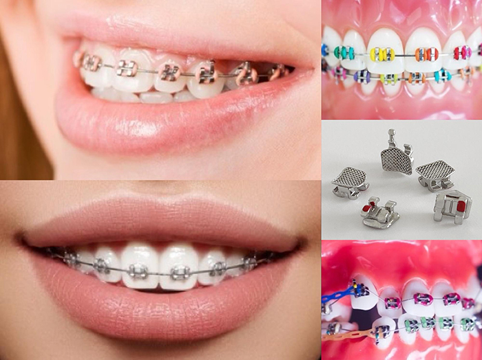 orthodontic brace (13).jpg