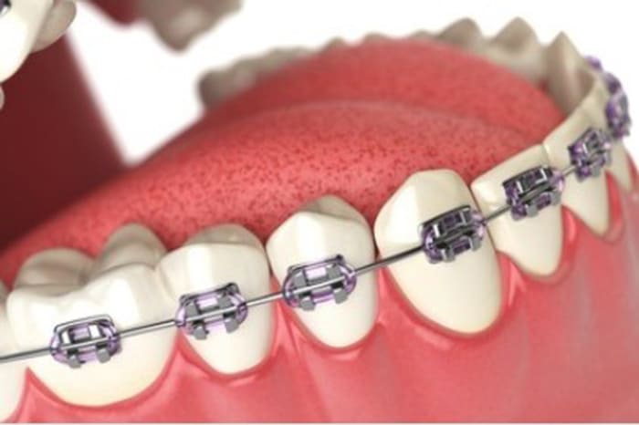 orthodontic brace (14).jpg